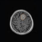 retrieval of brain tumor in contrast-enhanced MRI images