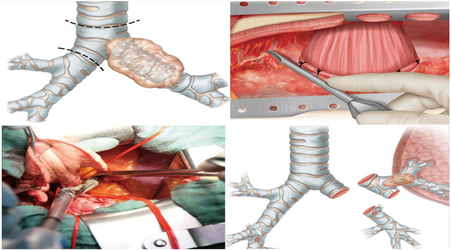 科学网 胸外科关键手术技术——肺切除及支气管成形术 科学出版社的博文