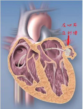 结构性心脏病介入治疗心脏封堵器科普博文