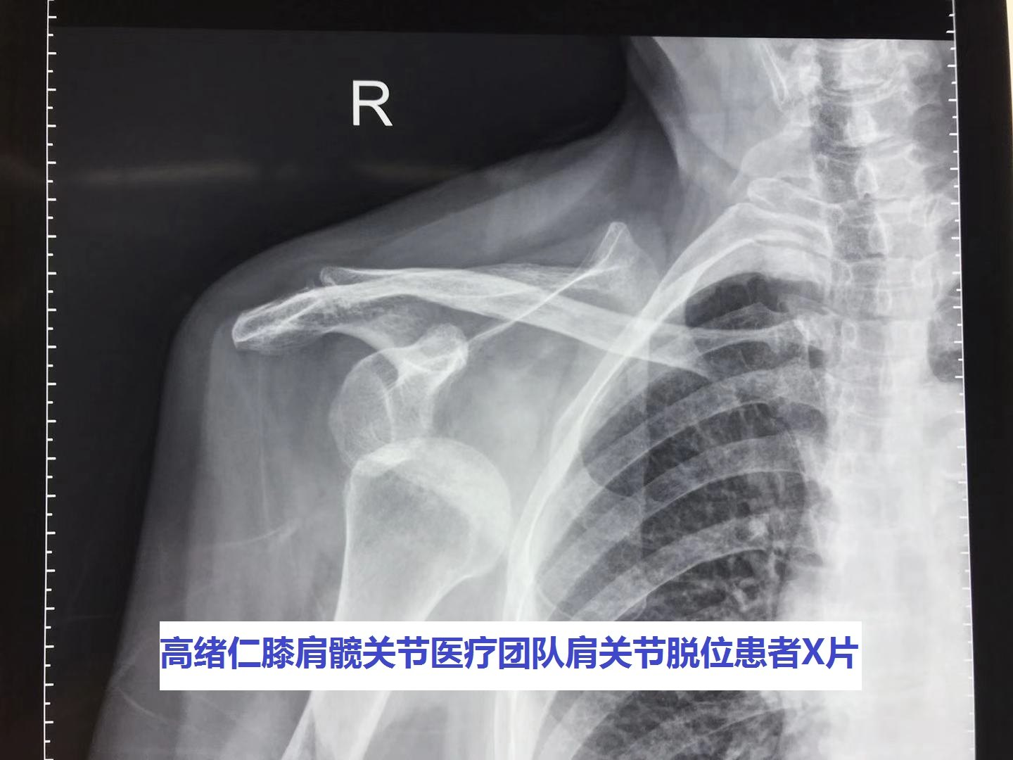 病例14 肩关节脱位-X线读片-医学