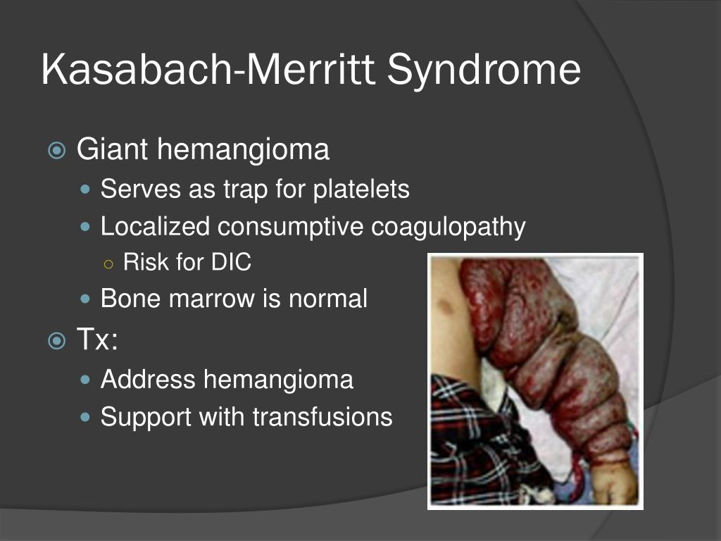 kasabach-merritt-syndrome-l.jpg