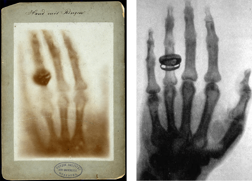 Left-X-ray-of-Anna-Bertrand-Roentgens-hand-1895-12-22 Albert-von 1896-01-23.png