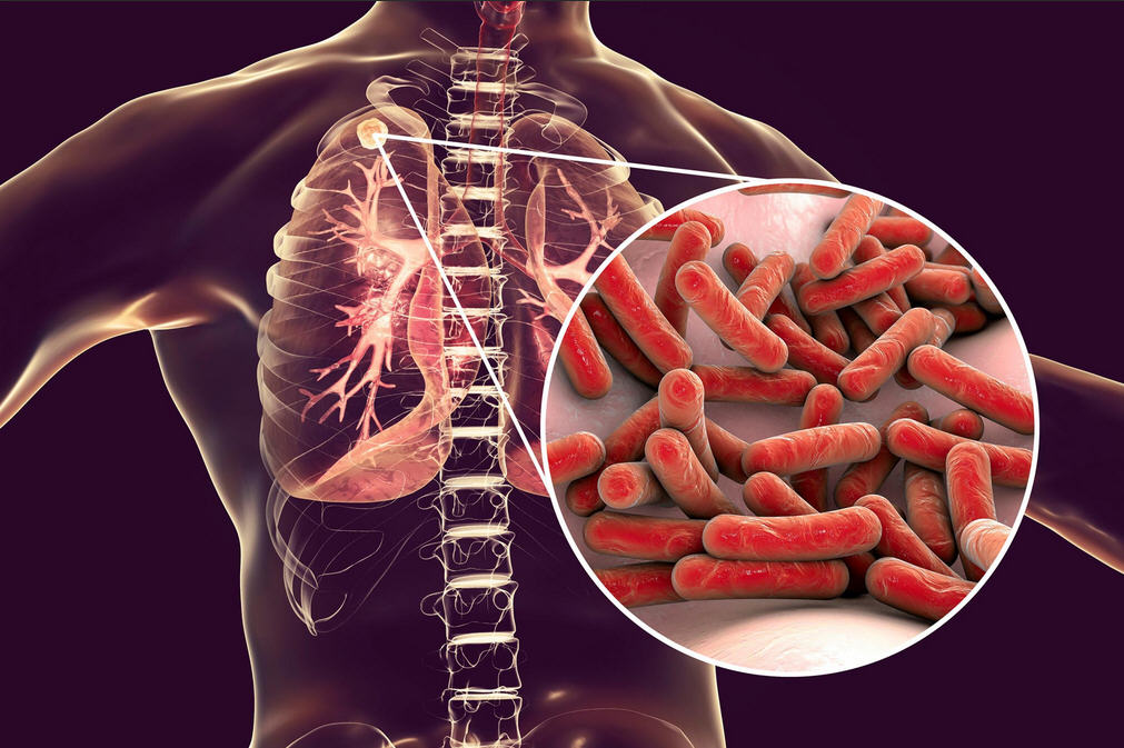 Secondary-Tuberculosis-Infection-Anatomy-Image.jpg