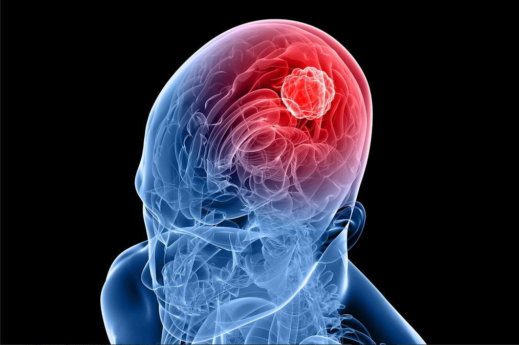 Brain-Cancer-Tumor-Illustration.jpg