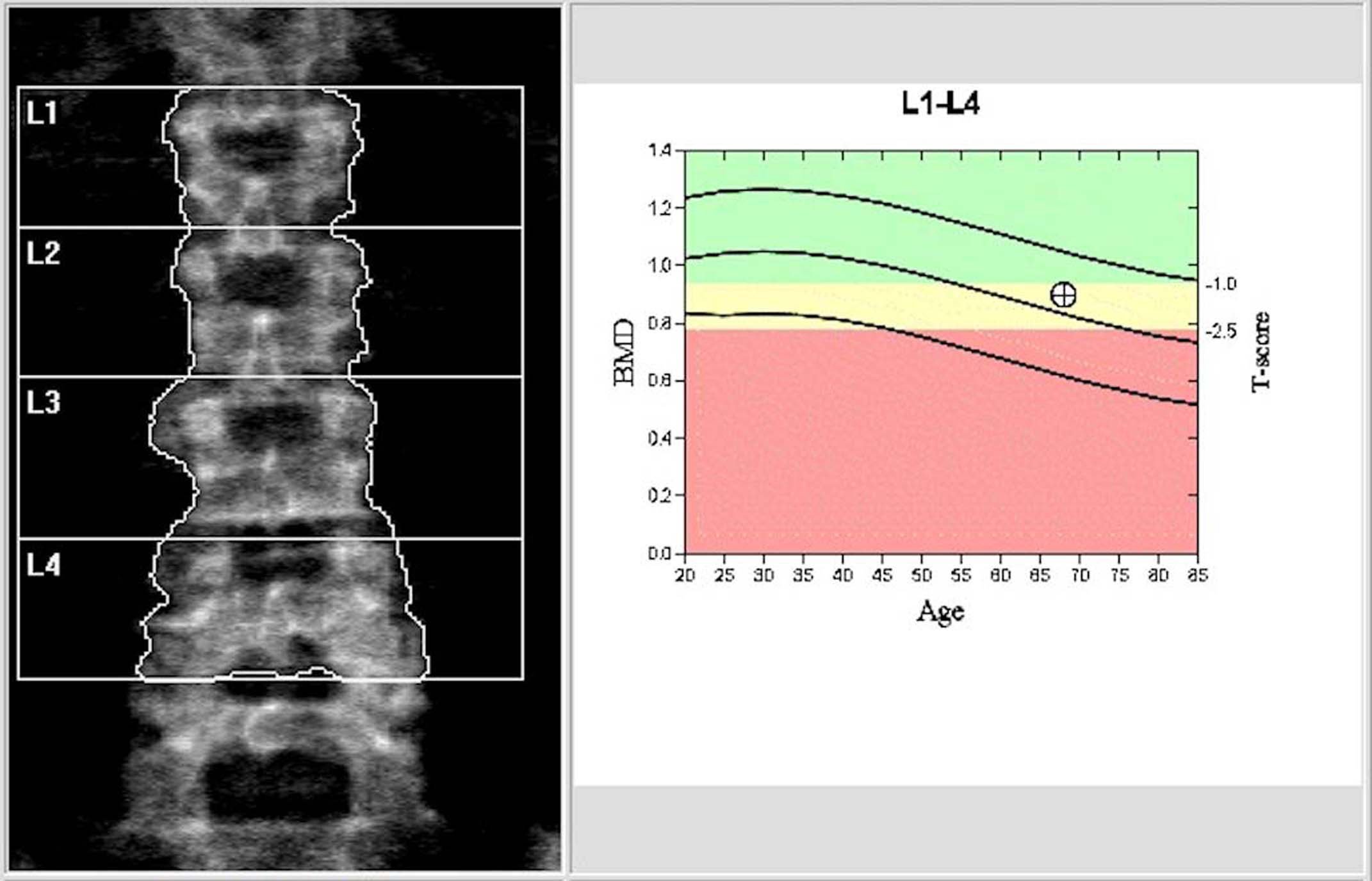 Bone-Density-Scan.jpg