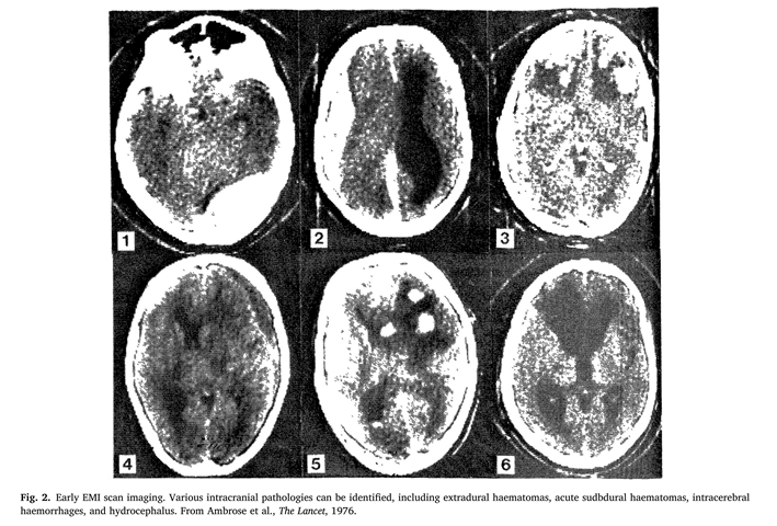 50 Years of the Glasgow Coma Scale A historical perspective_03(1).jpg