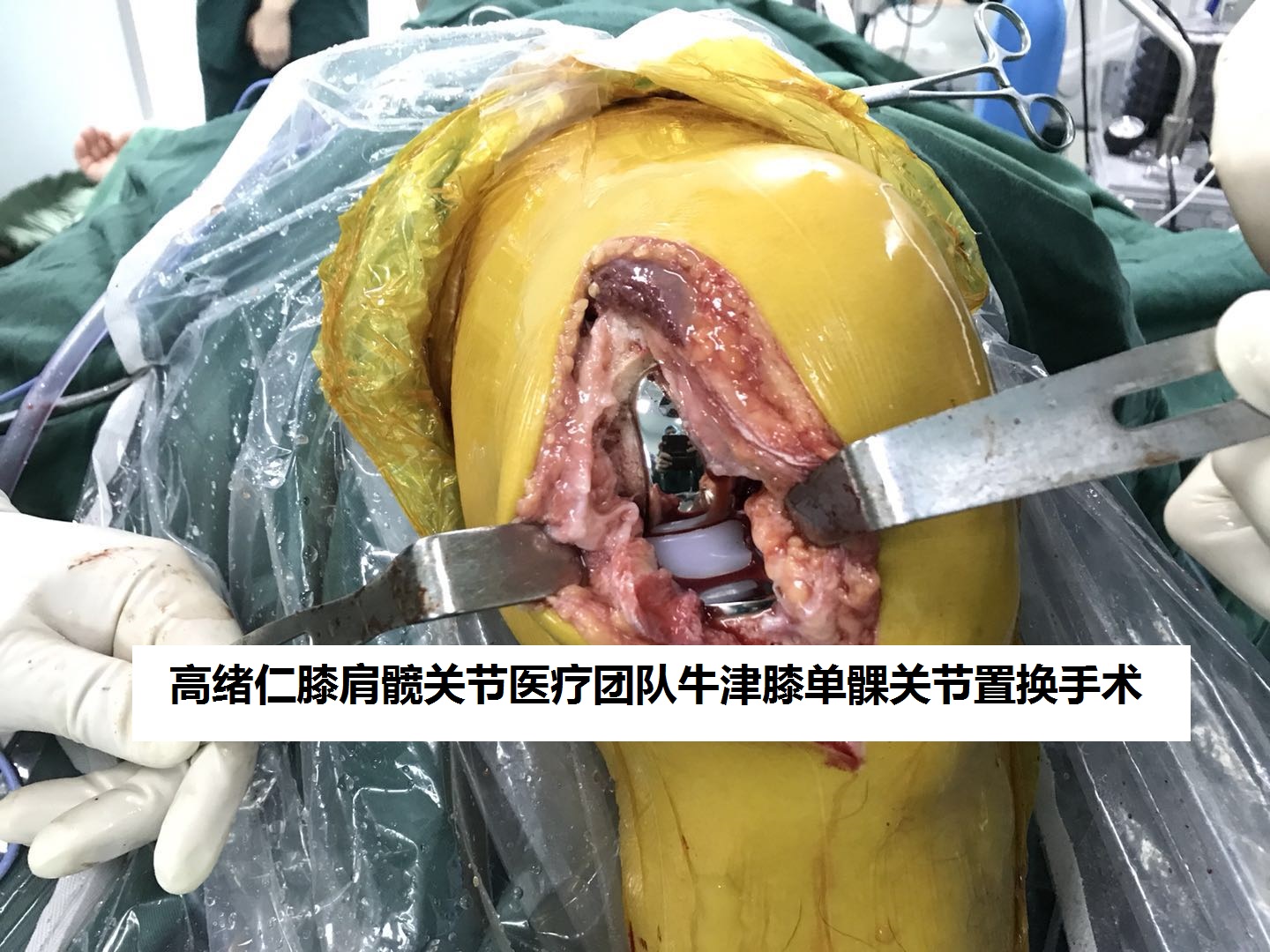 徐州宣武市场老板在徐州二院骨科进行膝关节炎单髁置换手术经验