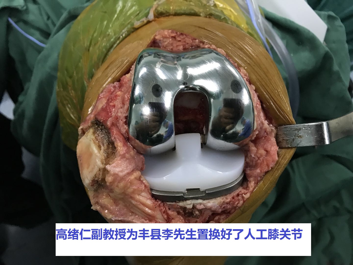 丰县宋楼70岁李先生徐州二院骨科人工膝关节置换手术过程照片