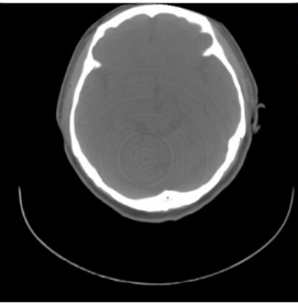 基于变分的ct图像环形伪影校正