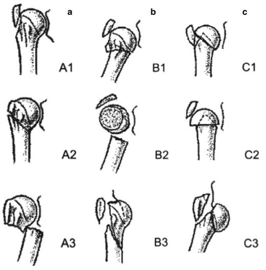 肩胛骨骨折分型解剖图图片