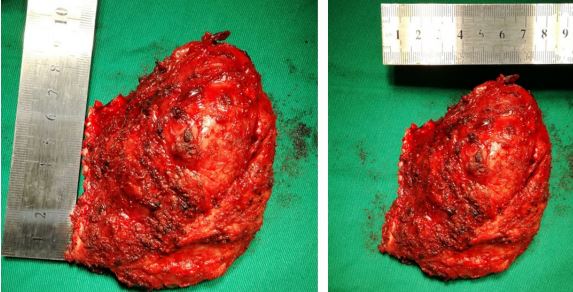 肩胛骨恶性肿瘤的图片图片