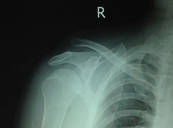 上图:高绪仁在主刀为肩关节复发性脱位肩胛盂骨缺损的患者进行